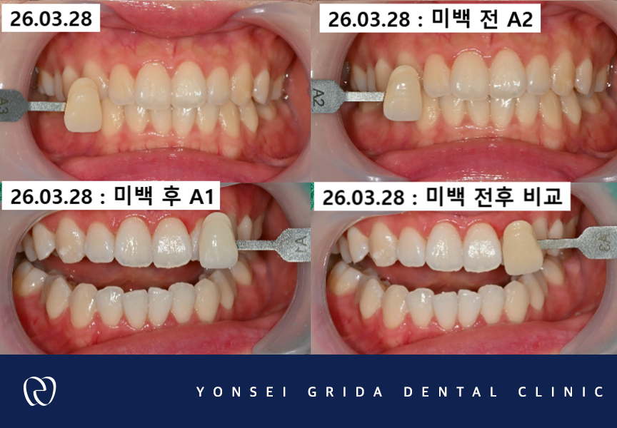 Yeomchang Station Dental Clinic: If You Want to Brighten Your Tooth Color in a Short Time with One-Day Whitening image 5