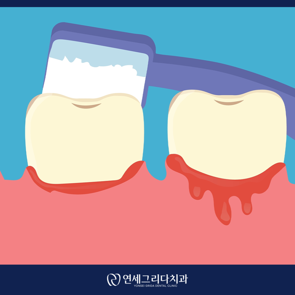 염창역잇몸치료, 양치할 때 자꾸 피가 난다면? 관련 이미지 6