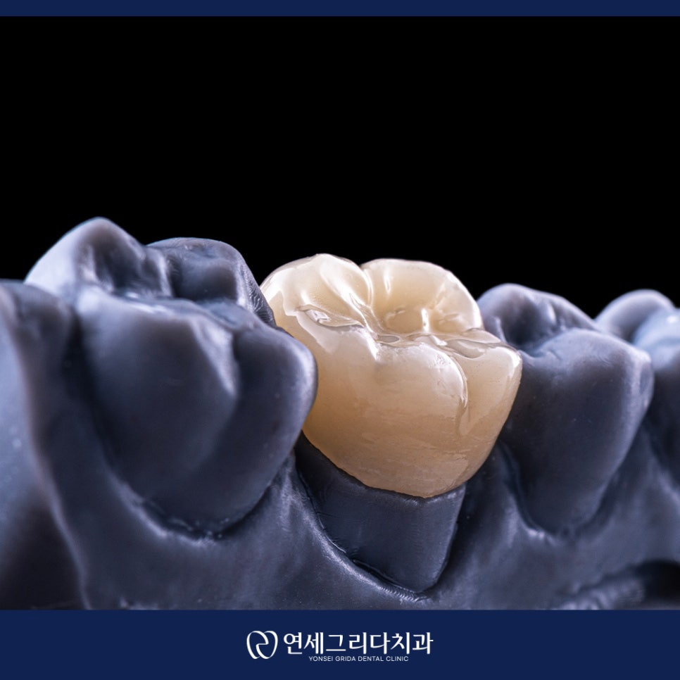 신경치료 후 보철 미루면 생기는 문제는? 관련 이미지 7