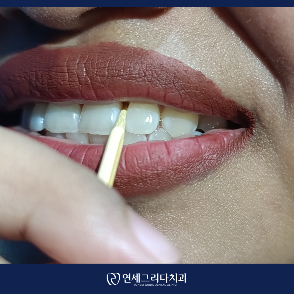 이쑤시개 사용, 치아 사이 음식물 뺄 때 괜찮을까요? 관련 이미지 4