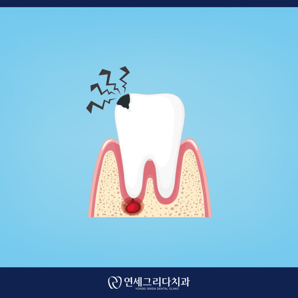 치근단 염증 잇몸에 고름이 생겼다면? 관련 이미지 2