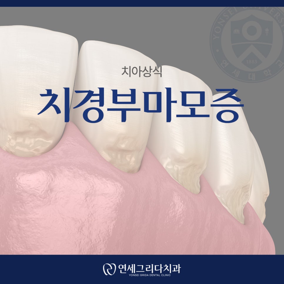 치경부마모증 시린 증상이 생겼다면? 관련 이미지 1