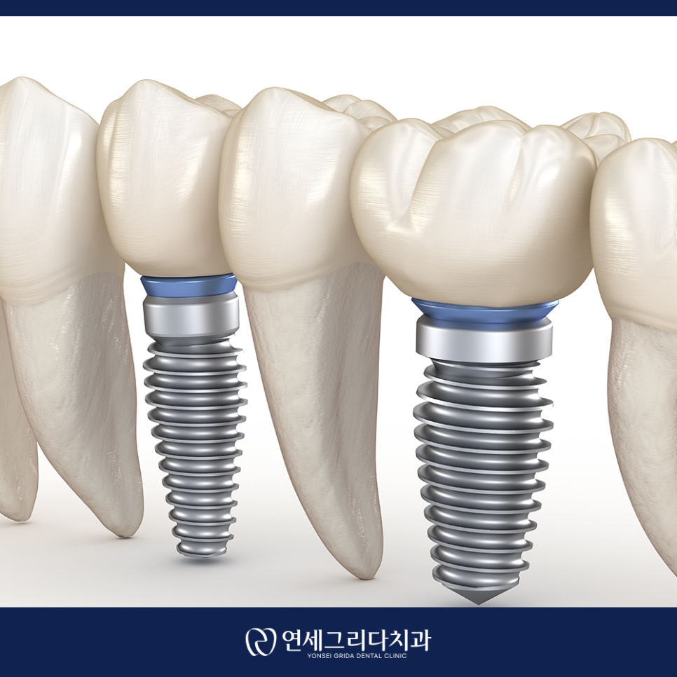 임플란트 후 식사 언제부터 가능할까? 관련 이미지 2