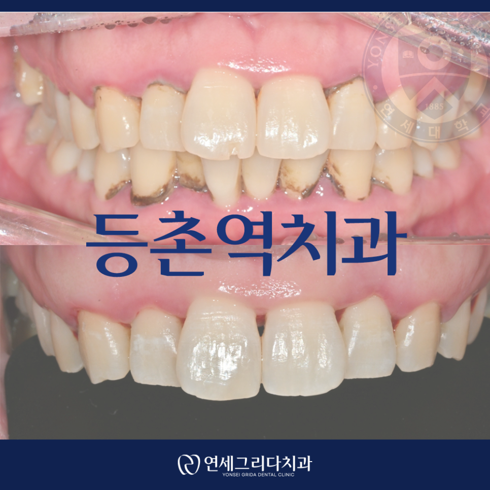 Deungchon Station Dental Clinic: My Front Tooth Broke and My Gums Hurt image 1