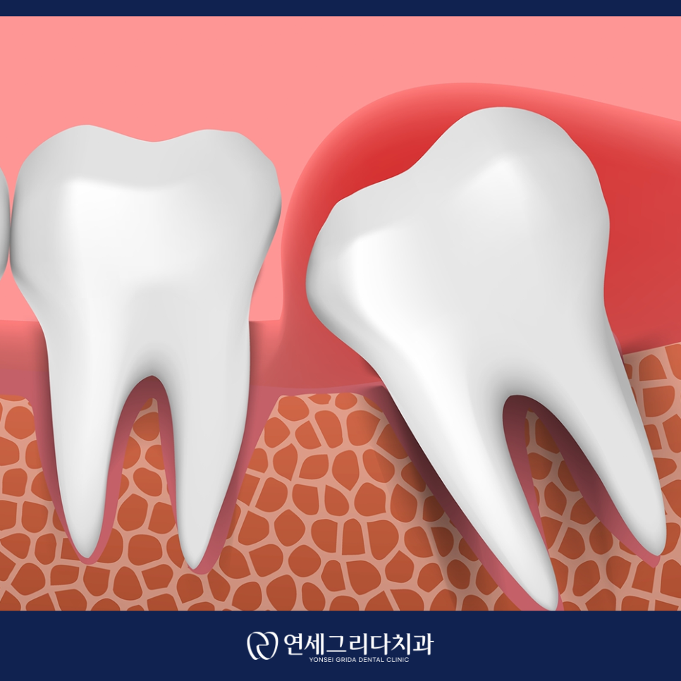 사랑니 발치 후 흡연, 꼭 알아야 할 주의사항 관련 이미지 5