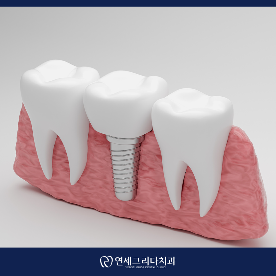 Yeomchang Station Implant, Treatment for Comfortable Eating and Recovery image 4