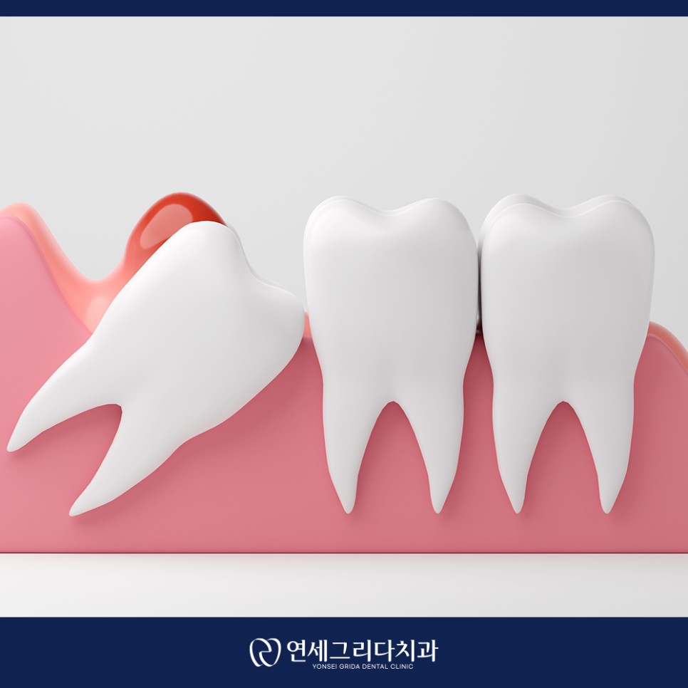 사랑니 발치 후 흡연, 꼭 알아야 할 주의사항 관련 이미지 4