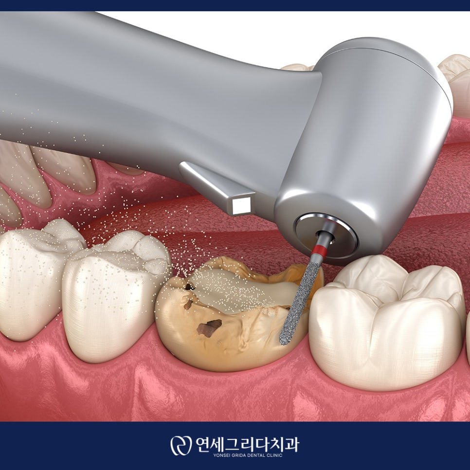 크라운 후 시림 계속 지속된다면? 관련 이미지 2