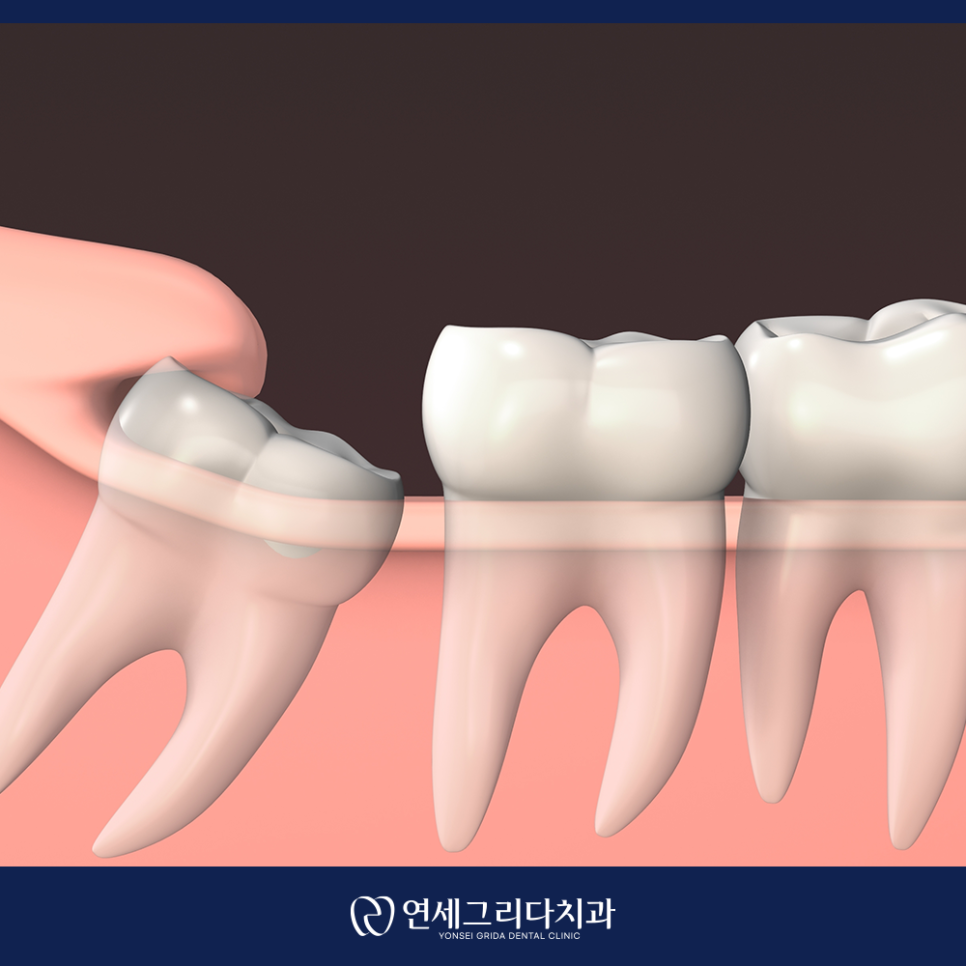 Do You Really Need to Have a Wisdom Tooth Removed at Yeomchang Station? image 5