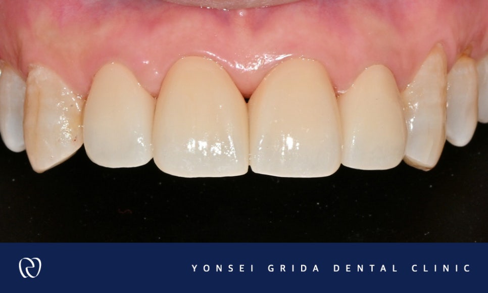 Recommended Dentist in Yeomchang-dong: My Front Teeth Are Chipped and Gapped image 7
