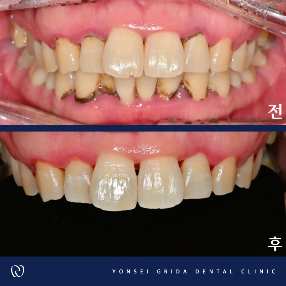 Deungchon Station Dental Clinic: My Front Tooth Broke and My Gums Hurt image 12