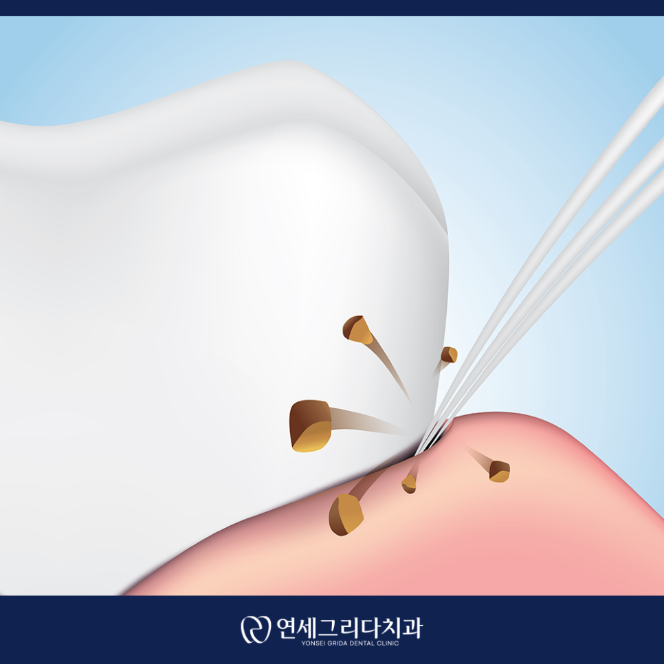 치간칫솔 사용법, 제대로 알고 쓰면 달라집니다! 관련 이미지 3