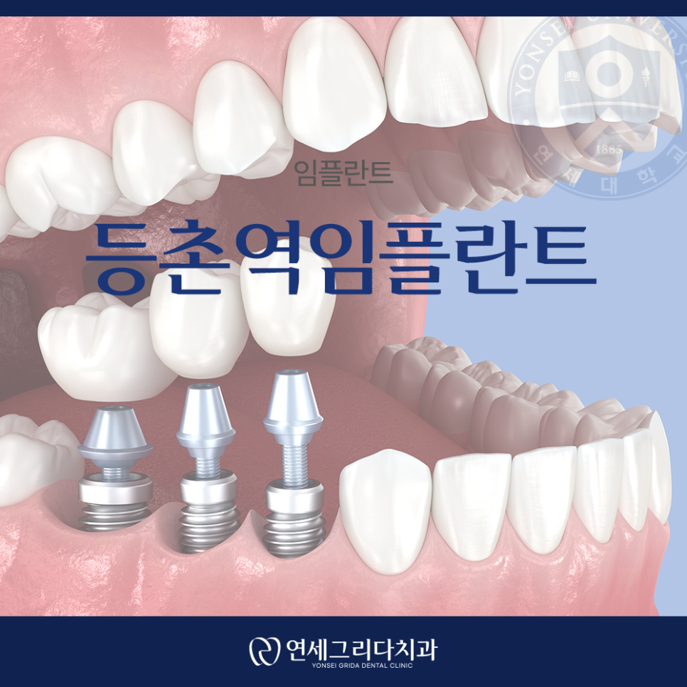 Deungchon Station Dental Implants: How to Use Them for as Long as Natural Teeth image 1