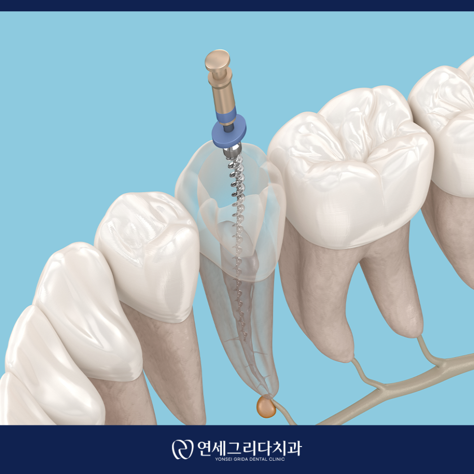 Yeomchang Station Root Canal Treatment: Addressing the Cause of Pain First image 3