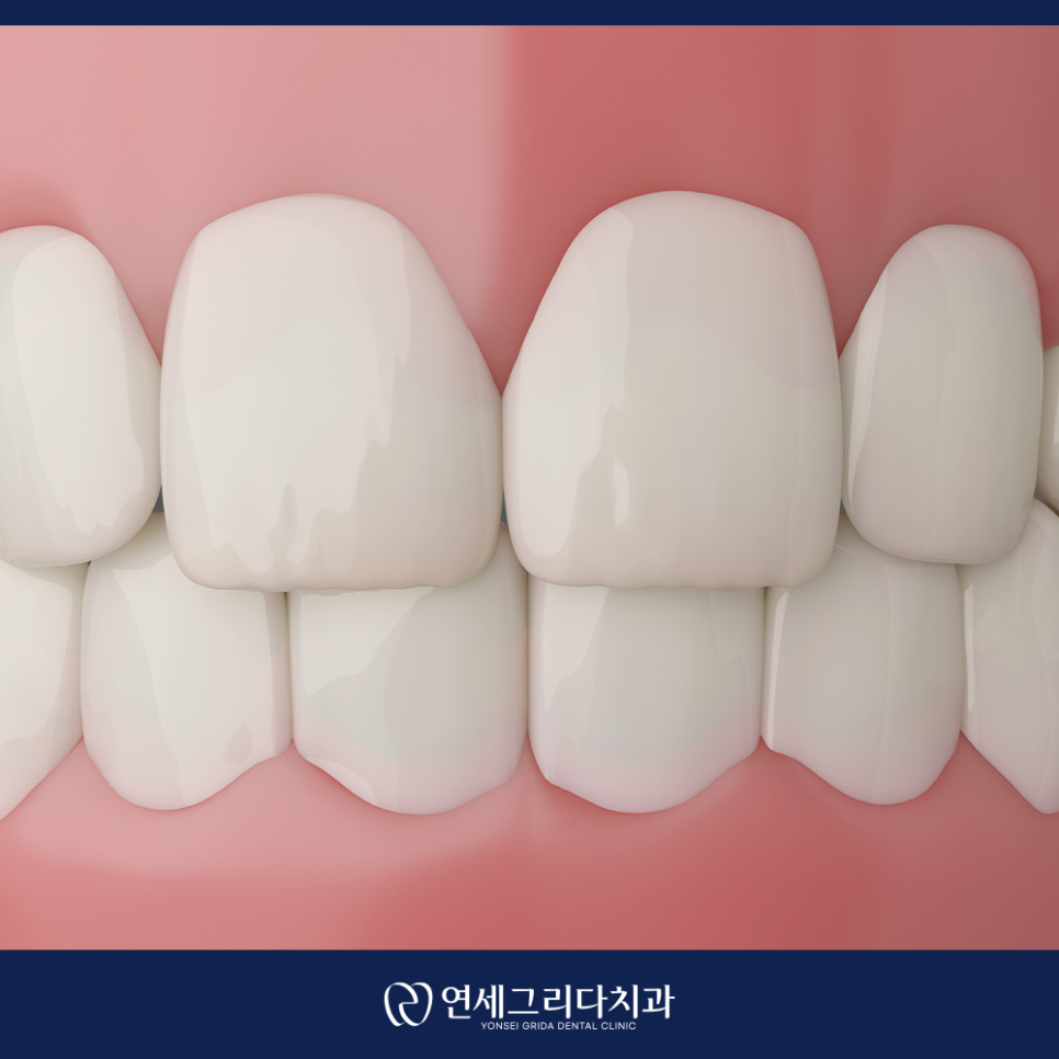 앞니 레진치료, 웃을 때 보이는 틈이 고민이라면 관련 이미지 4