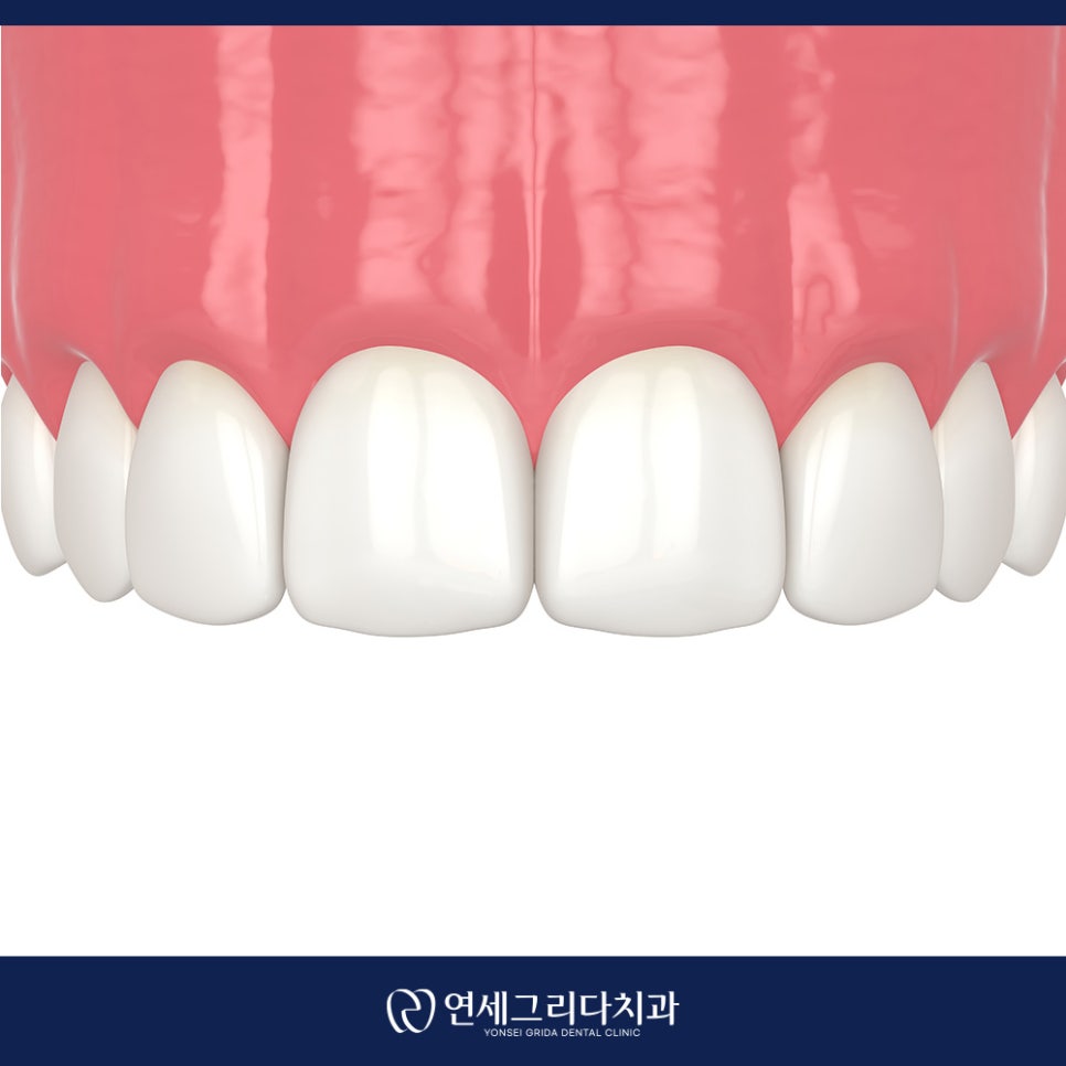 Recommended Dentist in Yeomchang-dong: My Front Teeth Are Chipped and Gapped image 6
