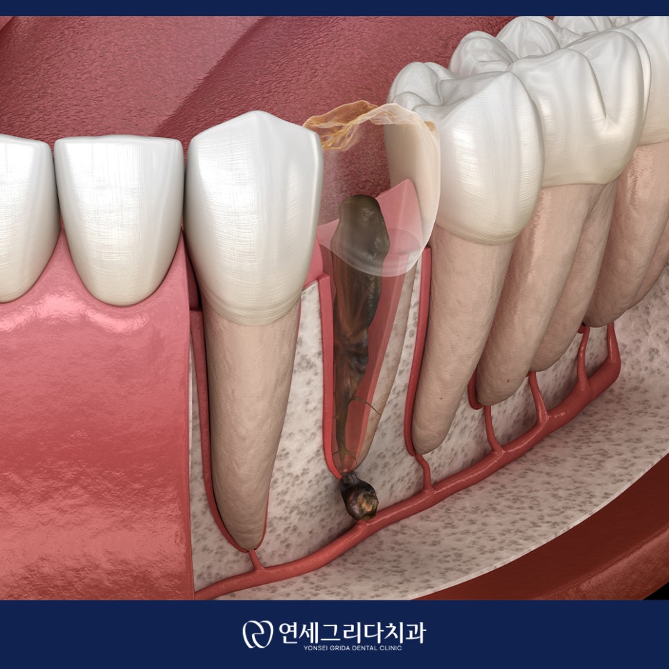 치근단 염증 잇몸에 고름이 생겼다면? 관련 이미지 6