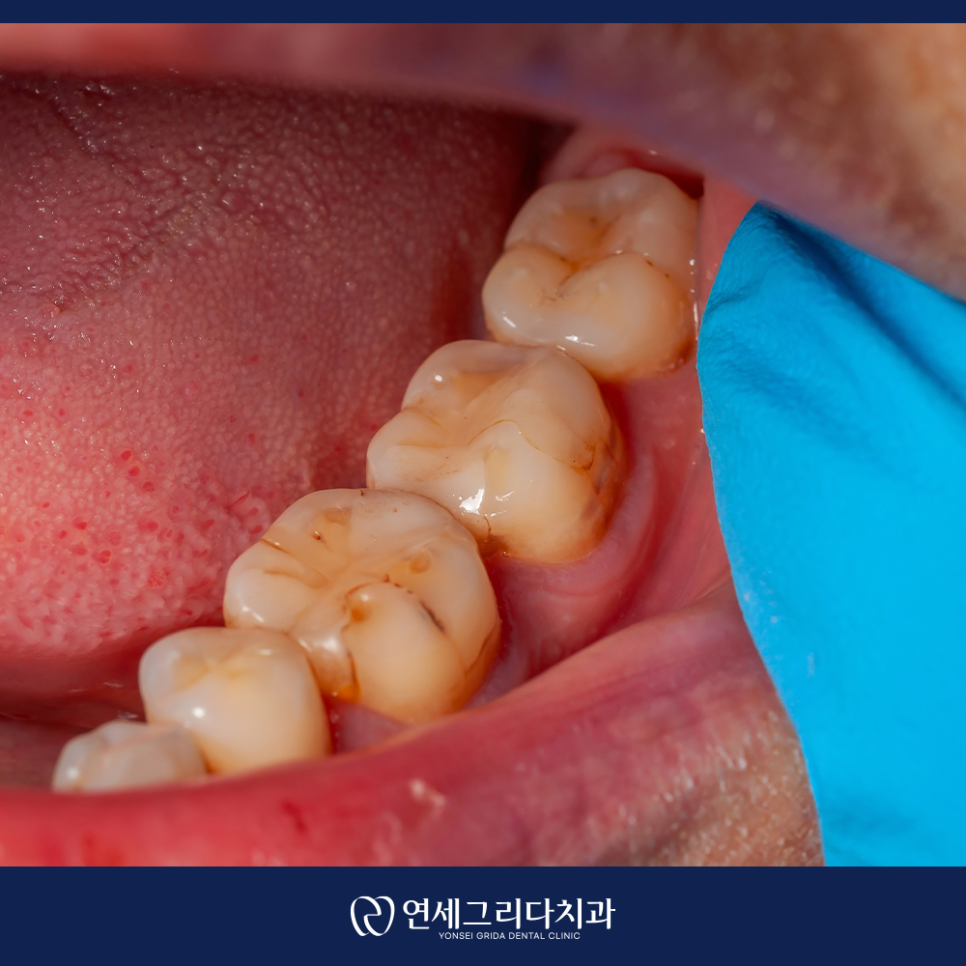 What Is That Black Spot on Your Tooth? Distinguishing Staining from Cavities image 4