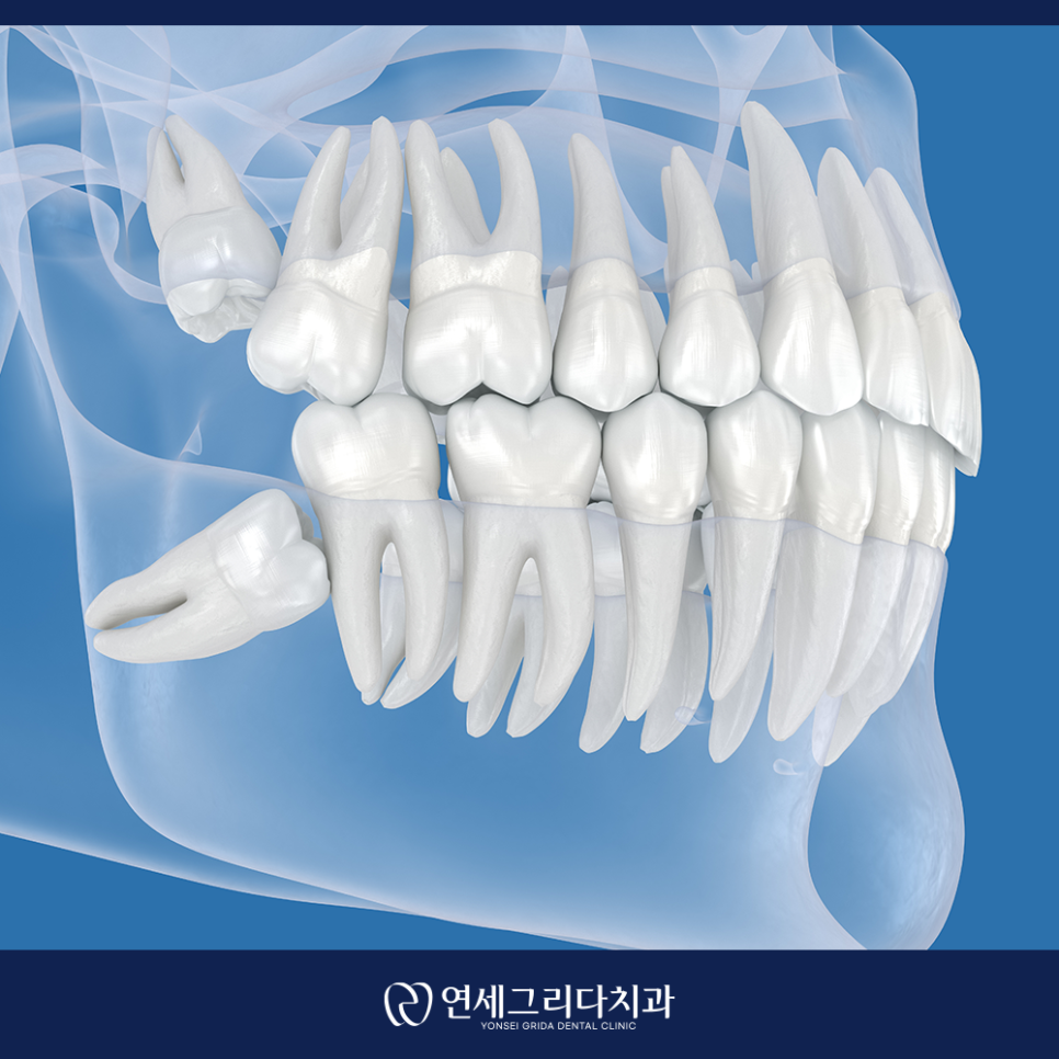 Do You Really Need to Have a Wisdom Tooth Removed at Yeomchang Station? image 2