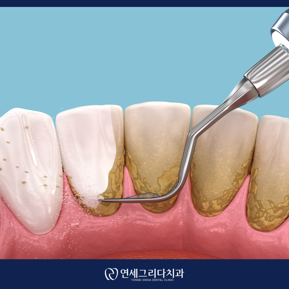 염창역스케일링, 피가 나는데 괜찮을까요? 관련 이미지 6
