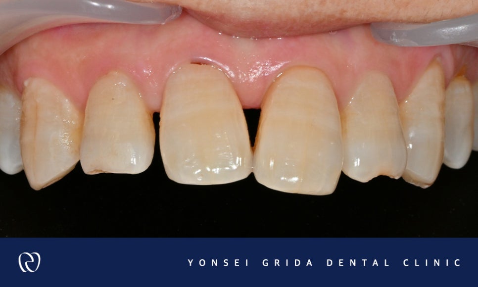 Recommended Dentist in Yeomchang-dong: My Front Teeth Are Chipped and Gapped image 4