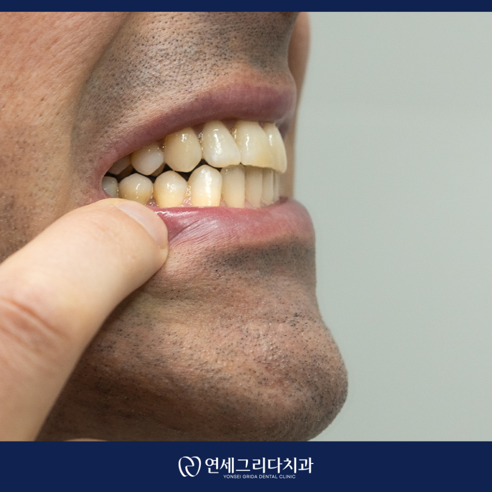 이쑤시개 사용, 치아 사이 음식물 뺄 때 괜찮을까요? 관련 이미지 6