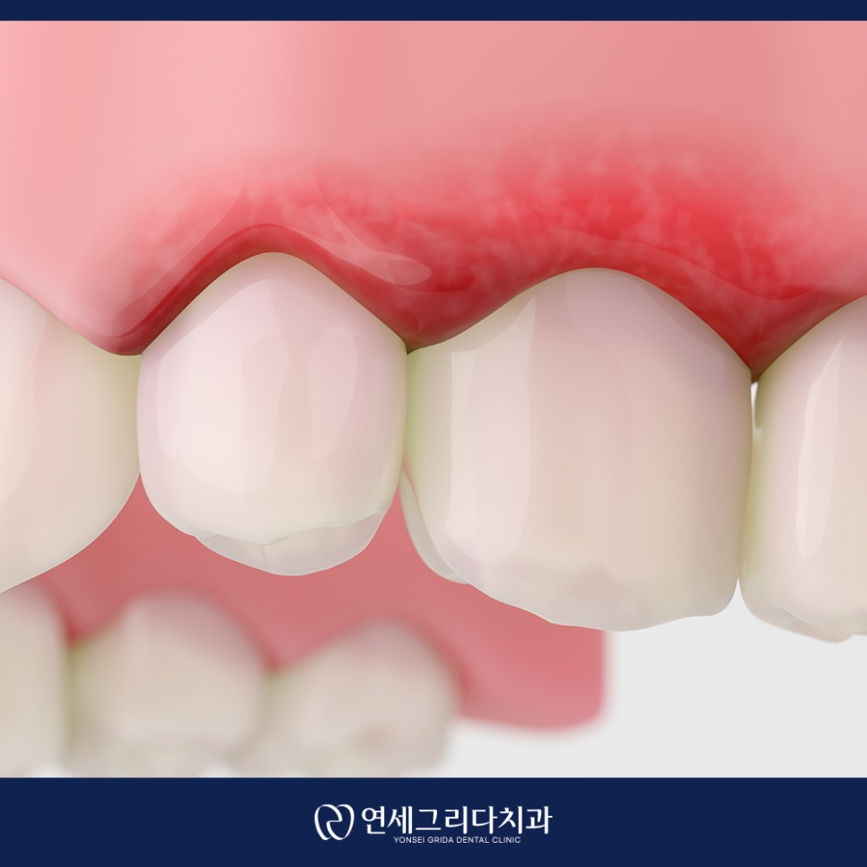 Check If Your Gums Bleed When Brushing: Symptoms of Gingivitis! image 5