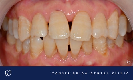Recommended Dentist in Yeomchang-dong: My Front Teeth Are Chipped and Gapped image 2