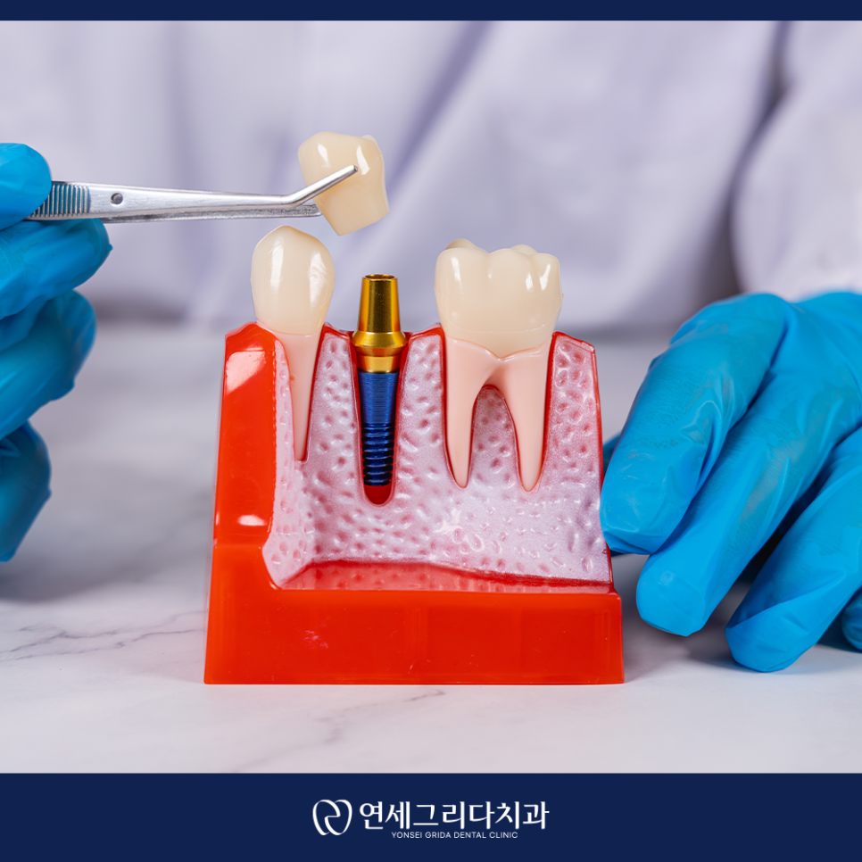 염창역치과, 임플란트 식립 후 흔들리는 느낌이 든다면? 관련 이미지 3