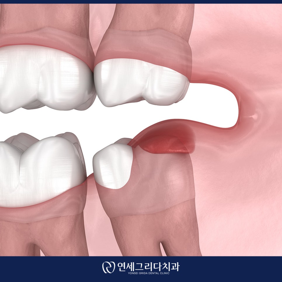 사랑니 잇몸 부음 그냥 두면 안 되는 이유는? 관련 이미지 2