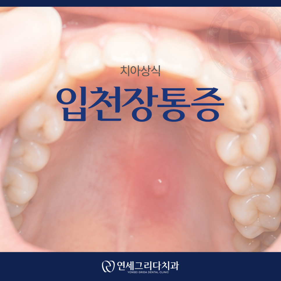 Why You Should Not Ignore Pain in the Roof of Your Mouth image 1