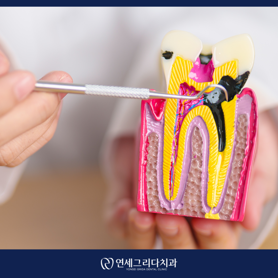 충치치료 통증, 무서워서 미루고 계셨나요? 관련 이미지 2