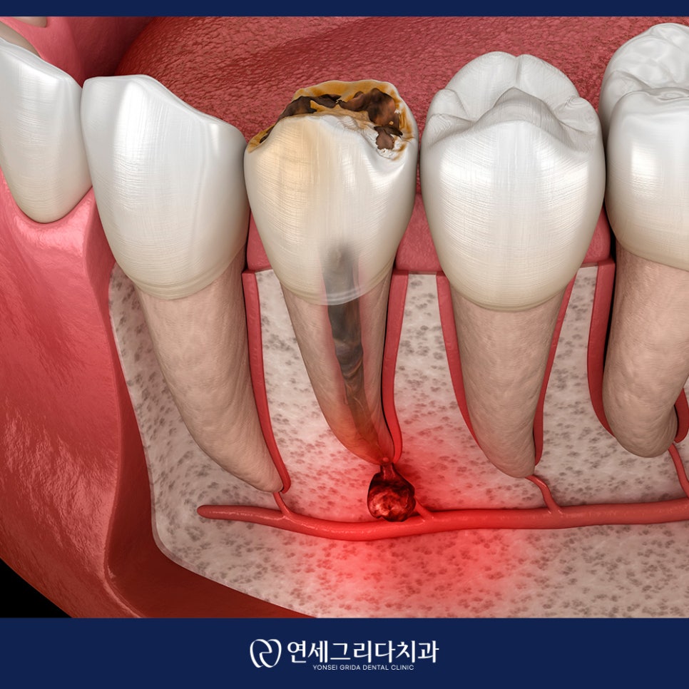 치근단 염증 잇몸에 고름이 생겼다면? 관련 이미지 5