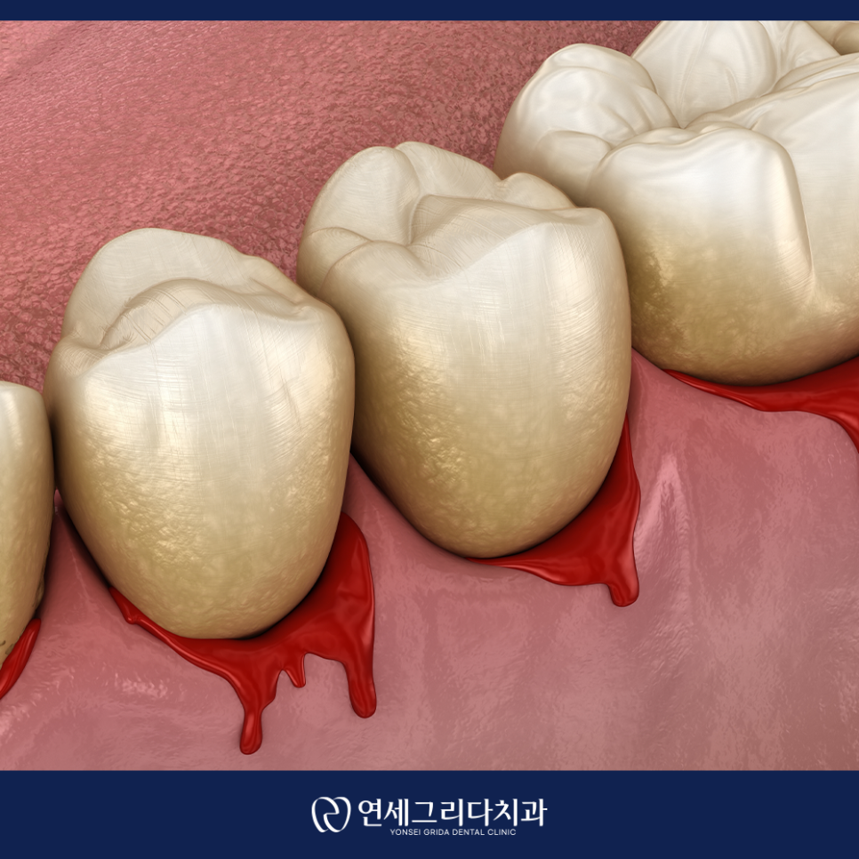 What Causes Blood to Pool in the Gums? image 4