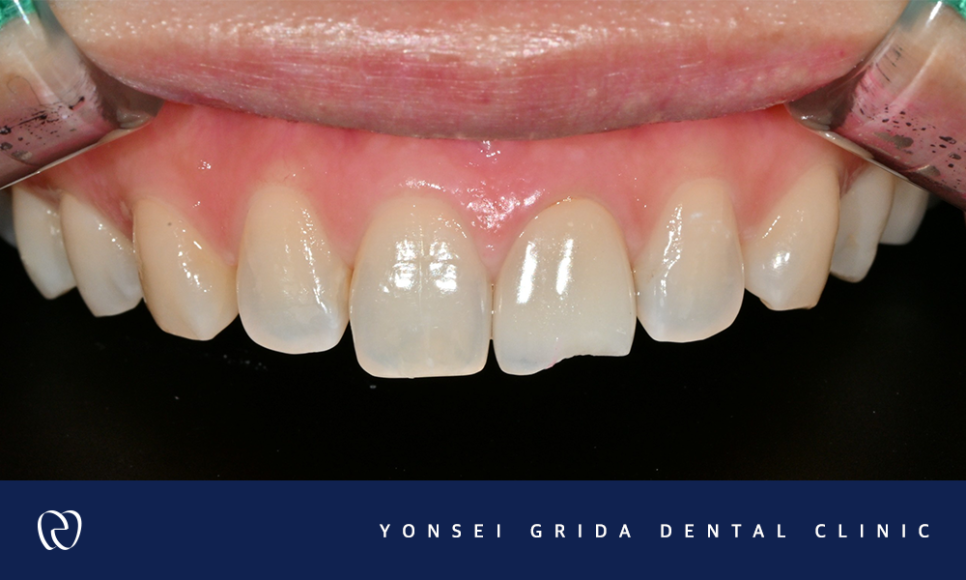 Yeomchang-dong Dental Clinic: The Crown I Had Treated Before Has Broken image 4
