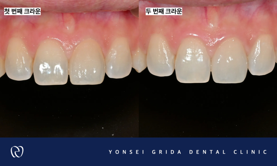 Yeomchang-dong Dental Clinic: The Crown I Had Treated Before Has Broken image 7