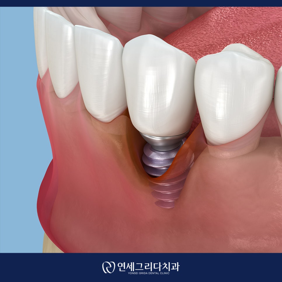 임플란트 흔들림 방치하면 생길 수 있는 문제는? 관련 이미지 2
