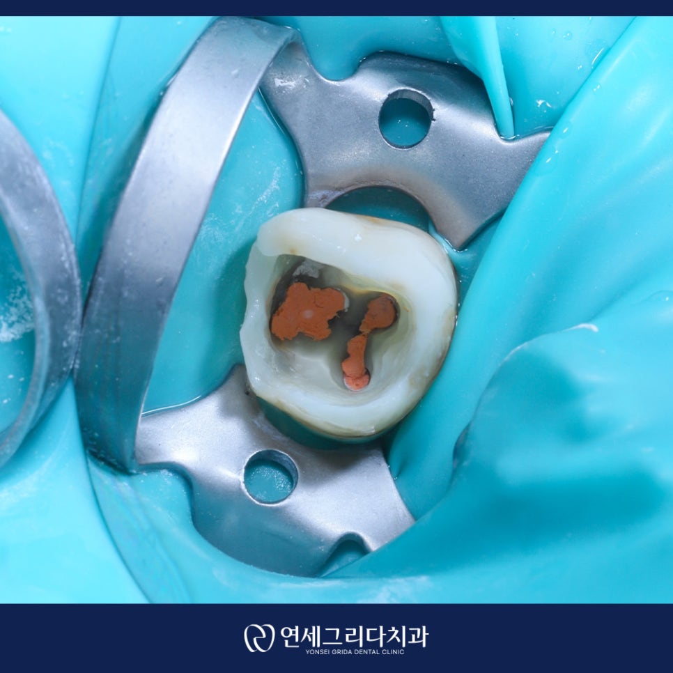 신경치료 후 보철 미루면 생기는 문제는? 관련 이미지 4