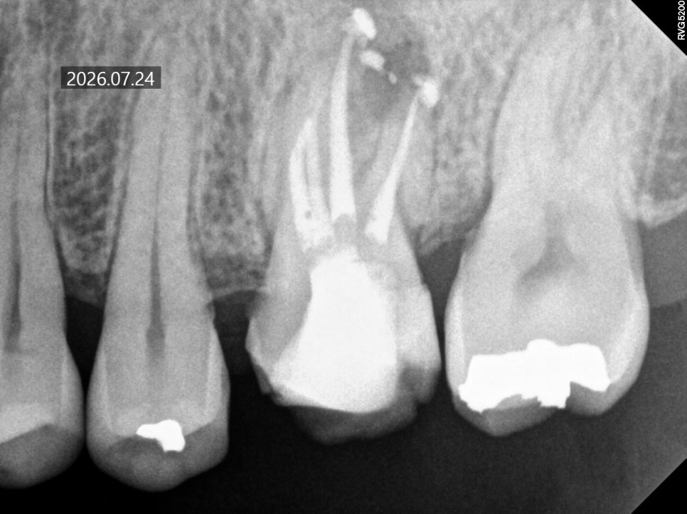 What Happens If You Leave Untreated Cavities Without Symptoms image 4