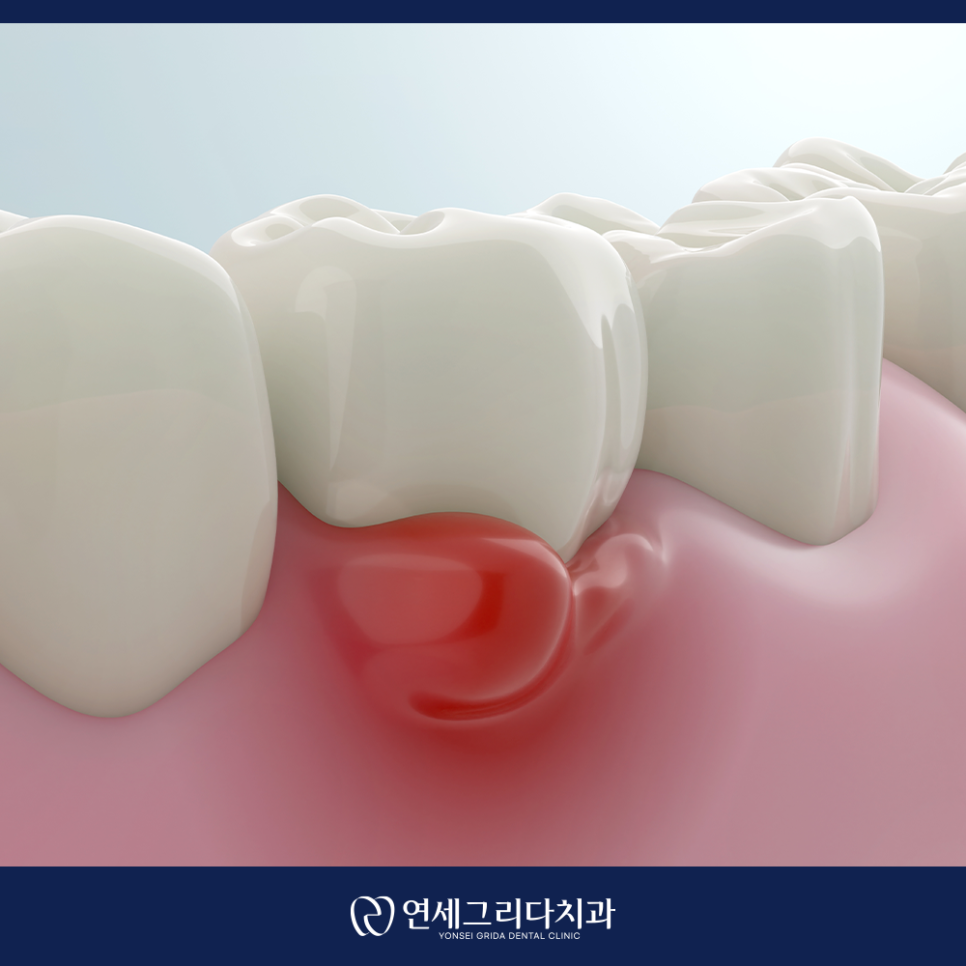 Check If Your Gums Bleed When Brushing: Symptoms of Gingivitis! image 4