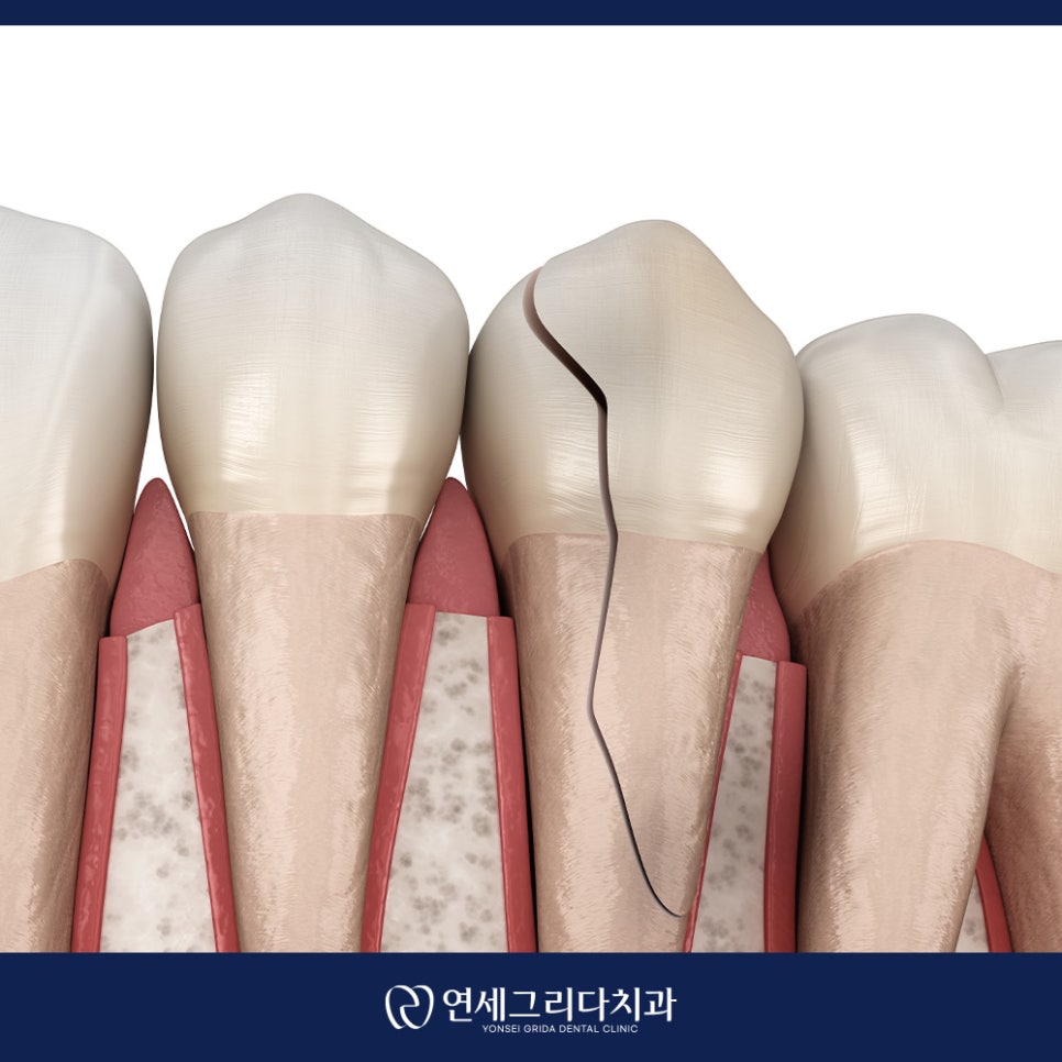 치아 크랙 씹을 때마다 통증이 생긴다면 관련 이미지 4