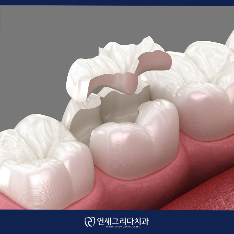 인레이 탈락 재부착이 가능할까요? 관련 이미지 2