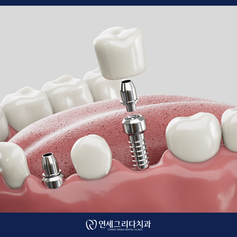 염창동임플란트 치과 선택 전 꼭 확인할 점 관련 이미지 6