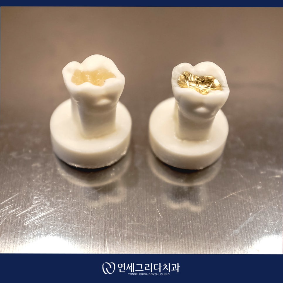 인레이 탈락 재부착이 가능할까요? 관련 이미지 8