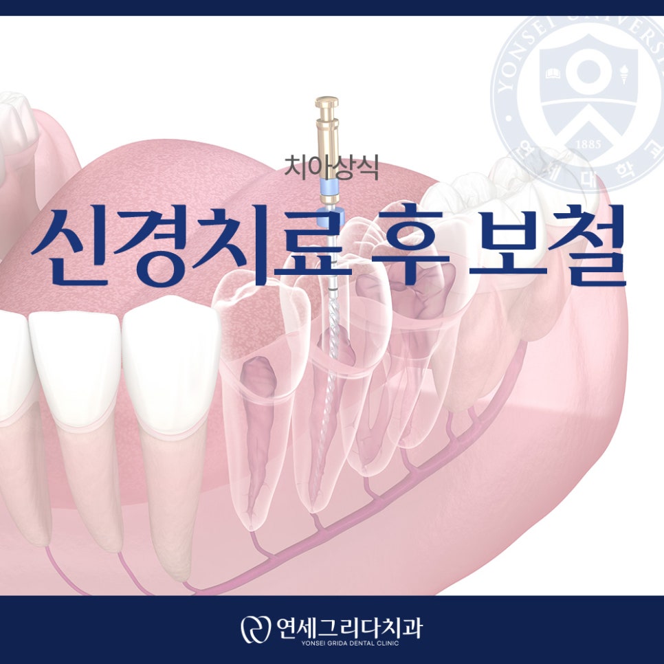 신경치료 후 보철 미루면 생기는 문제는? 관련 이미지 1