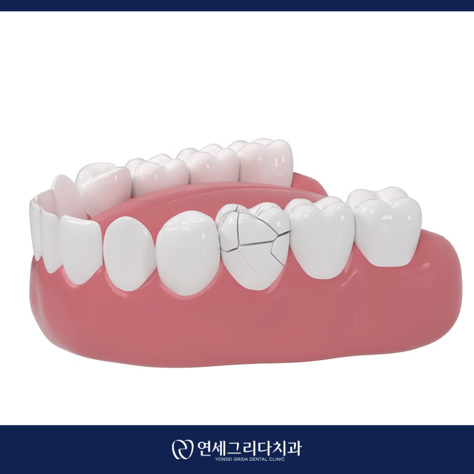 신경치료 후 보철 미루면 생기는 문제는? 관련 이미지 3