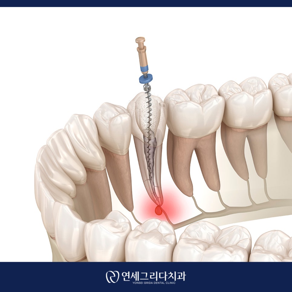 치근단 염증 잇몸에 고름이 생겼다면? 관련 이미지 4