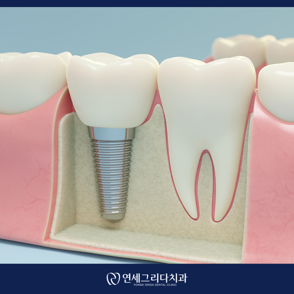Yeomchang Station Implant, Treatment for Comfortable Eating and Recovery image 3