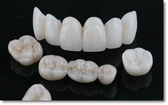 A Complete Guide to the Differences Between All-Ceramic, Zirconia, and PFM Dental Crowns image 5