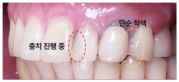 역삼동 치과, 10년 전 레진&middot;크라운 교체가 필요한 위험 신호 5가지 관련 이미지 4